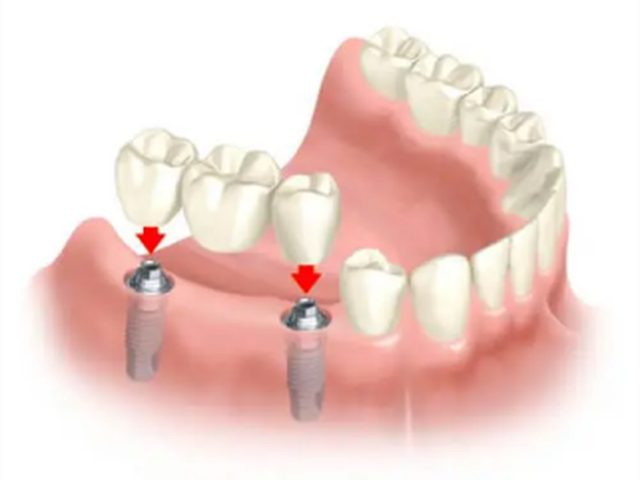 Puente dental sobre implantes sustituyendo varias piezas